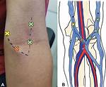Do We Cannulate Artery?