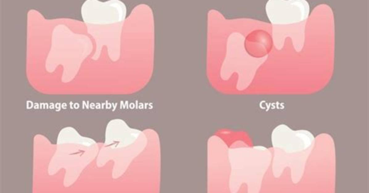 Do Wisdom Teeth Hurt?
