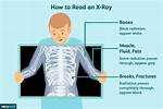 Do X Rays Hurt?