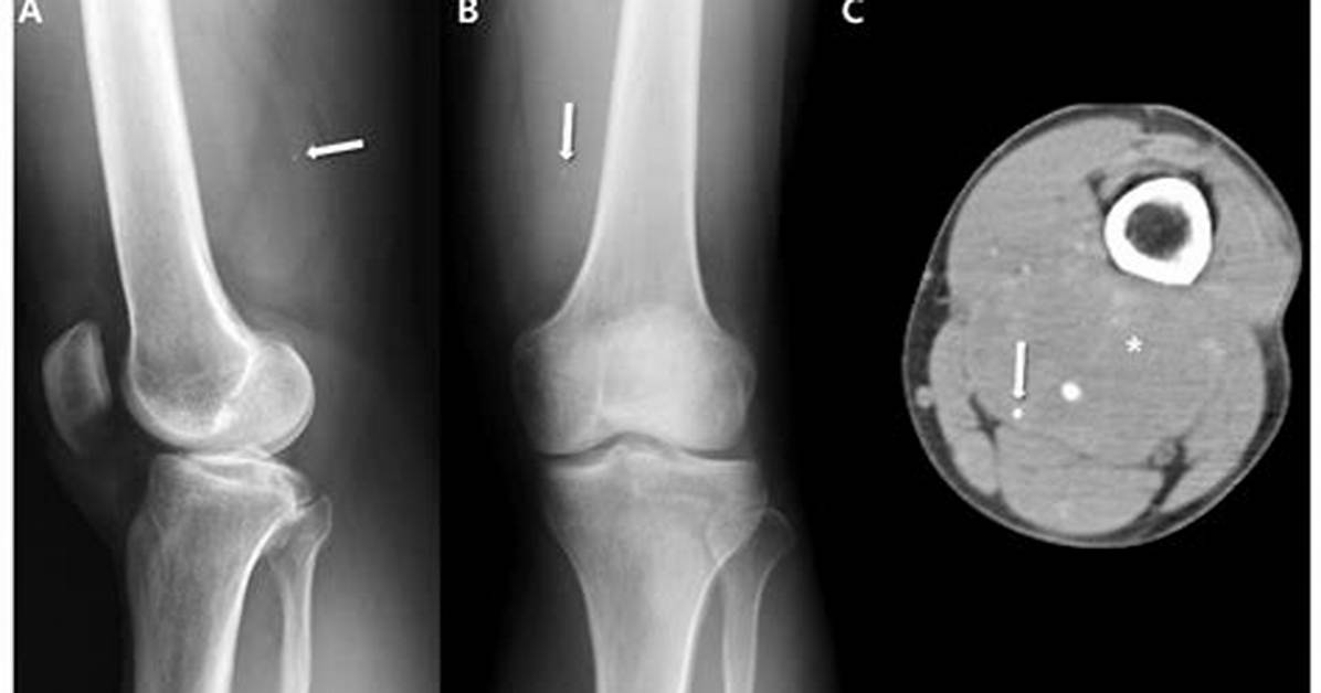 Do X Rays Show Sarcomas?