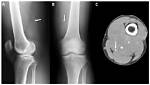 Do X Rays Show Sarcomas?