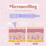 Do You Tip for Micro Needling?
