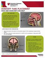 Dobhoff Placement
