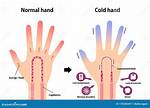 Does a Broken Hand Feel Cold?