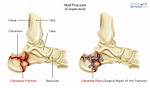 Does a Broken Heel Bone Require Surgery?