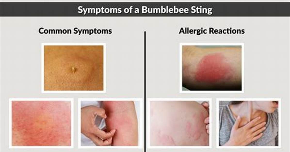 Does a Bumblebee Sting Hurt?