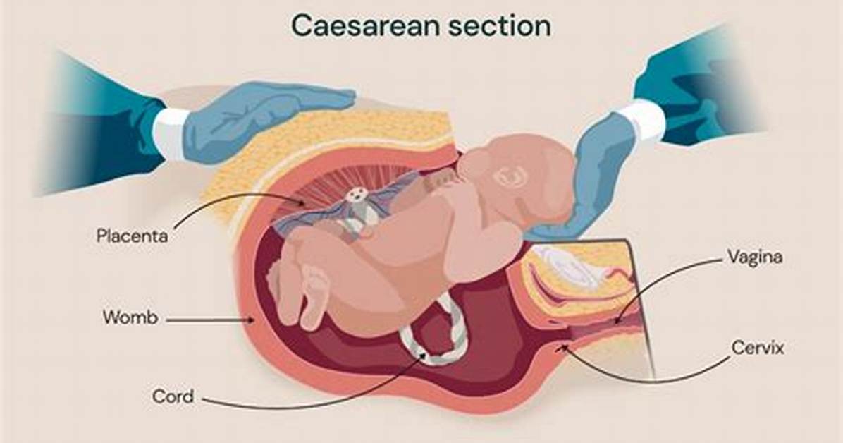 Does a C Section Work?