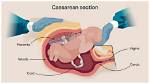 Does a C Section Work?