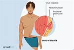 Does a Hernia Go Away?