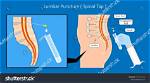 Does a Spinal Tap Hurt?