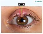 Does a Stye Cause Gunk?