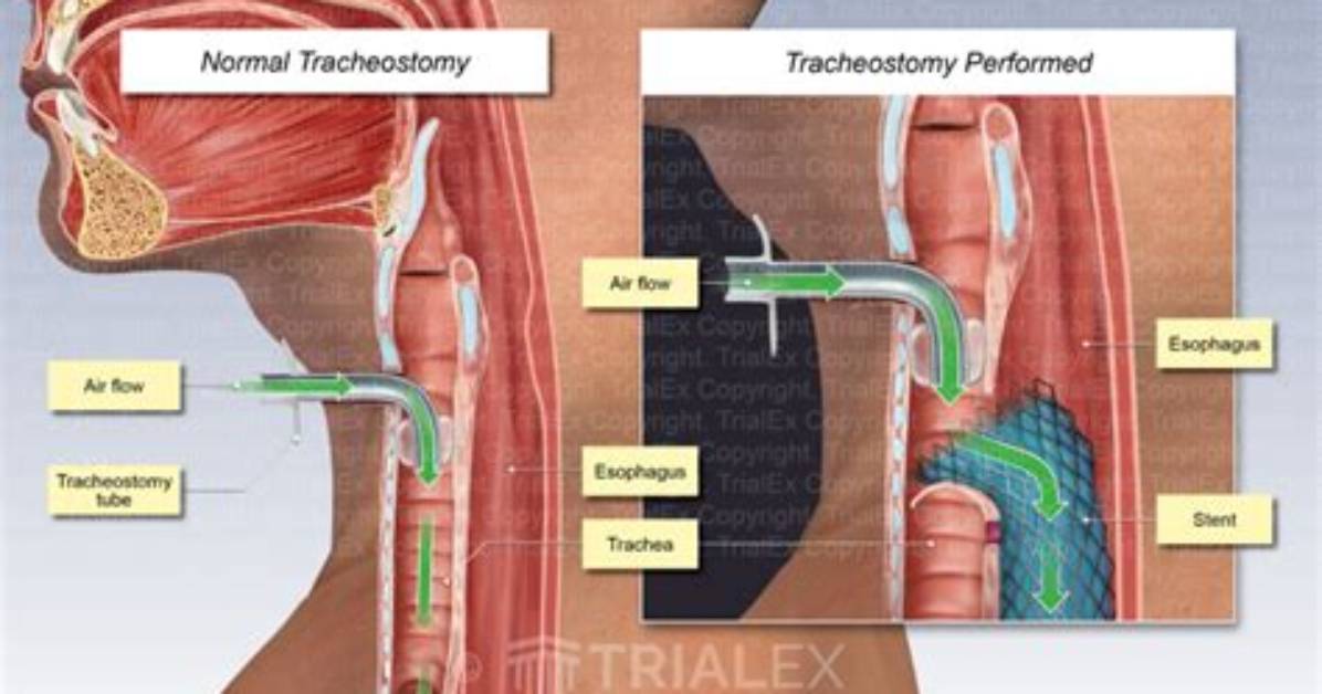 Does a Tracheostomy Hurt?