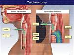 Does a Tracheostomy Hurt?