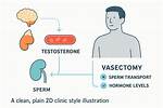 Does a Vasectomy Affect Testosterone