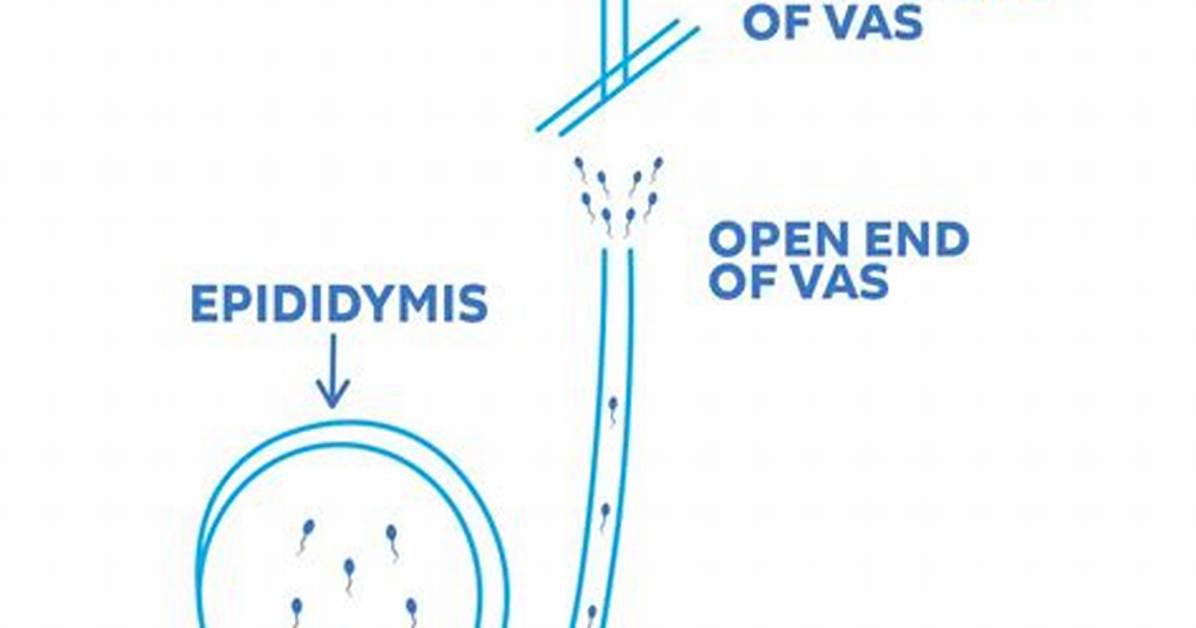 Does a Vasectomy Involves Severing the Ejaculatory Ducts?