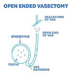 Does a Vasectomy Involves Severing the Ejaculatory Ducts?