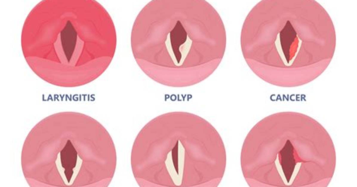 Does a Videostroboscopy Hurt?