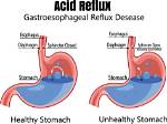 Does Acid Reflux Hurt?