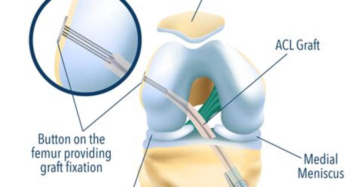 Does Acl Avulsion Require Surgery?