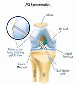 Does Acl Avulsion Require Surgery?