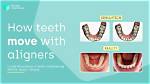Does Aligners Really Work?