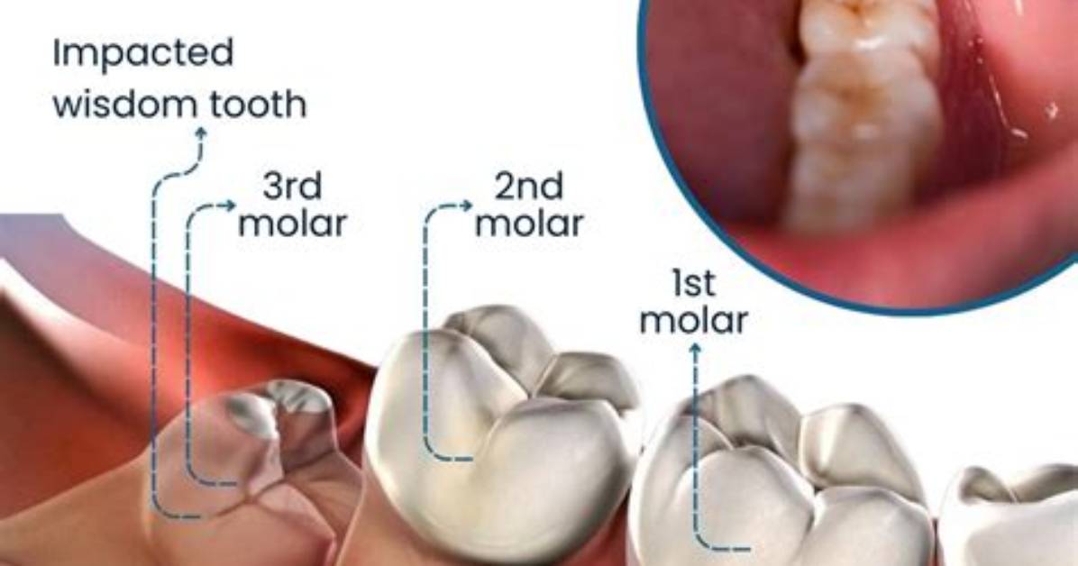 Does All Wisdom Teeth Hurt?