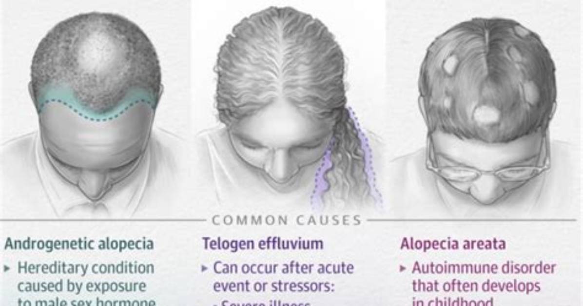 Does Alopecia Spread Quickly?