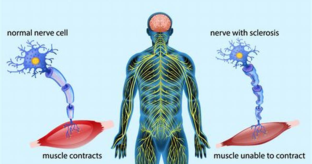 Does Als Start on One Side