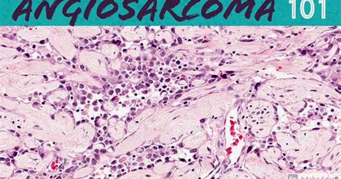 Does Angiosarcoma Come Back?