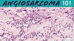 Does Angiosarcoma Come Back?