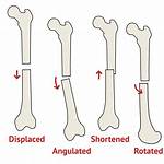 Does Angulated Mean Displaced?