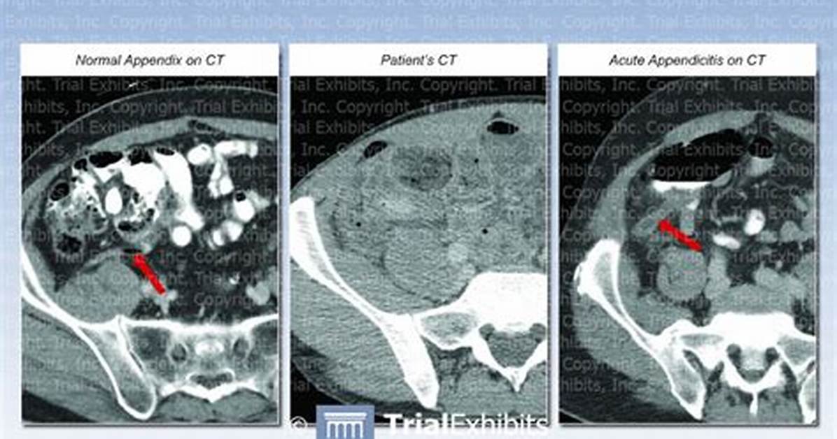 Does Appendix Show on Ct Scan?