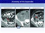 Does Appendix Show on Ct Scan?