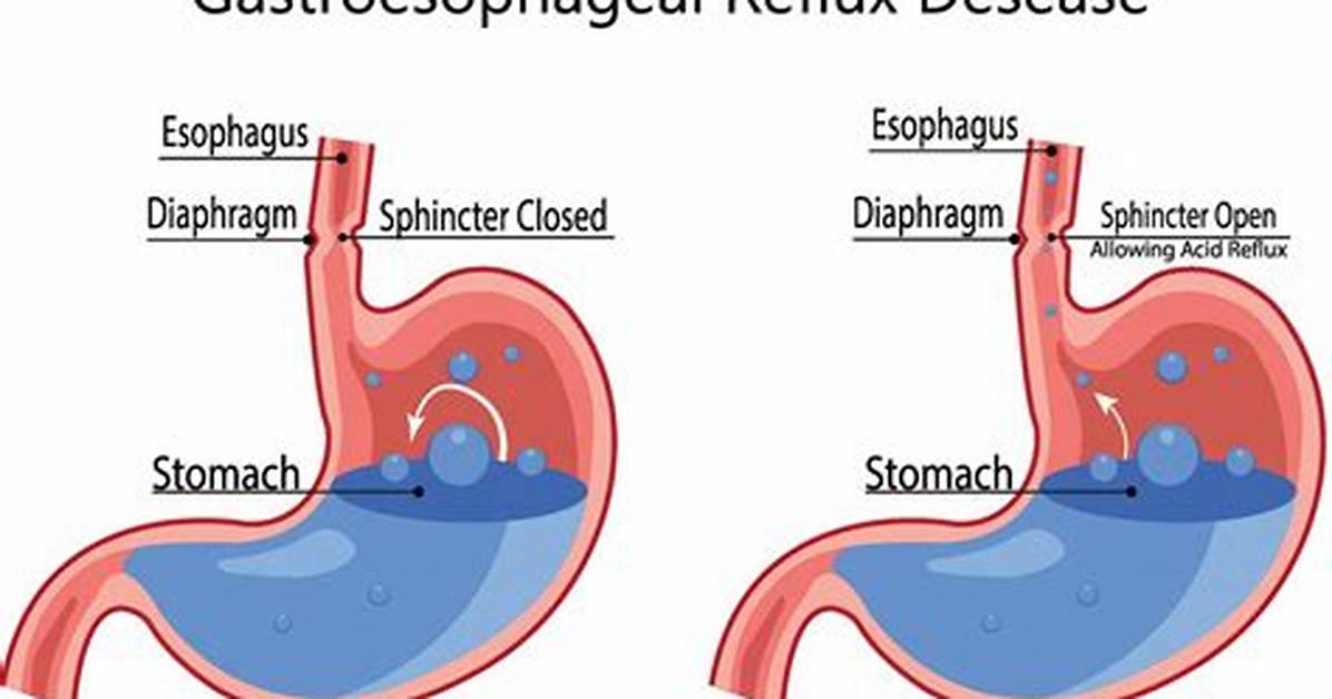 Does Ascorbic Acid Cause Acid Reflux?
