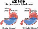 Does Ascorbic Acid Cause Acid Reflux?