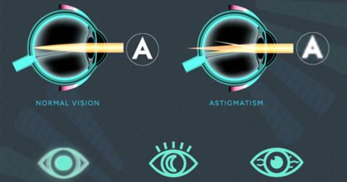 Does Astigmatism Cause Squinting?