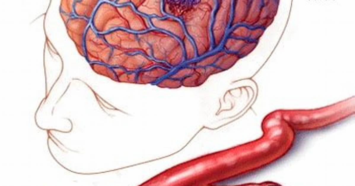 Does Avm Cause Brain Damage?