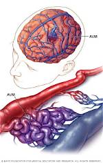 Does Avm Cause Brain Damage?