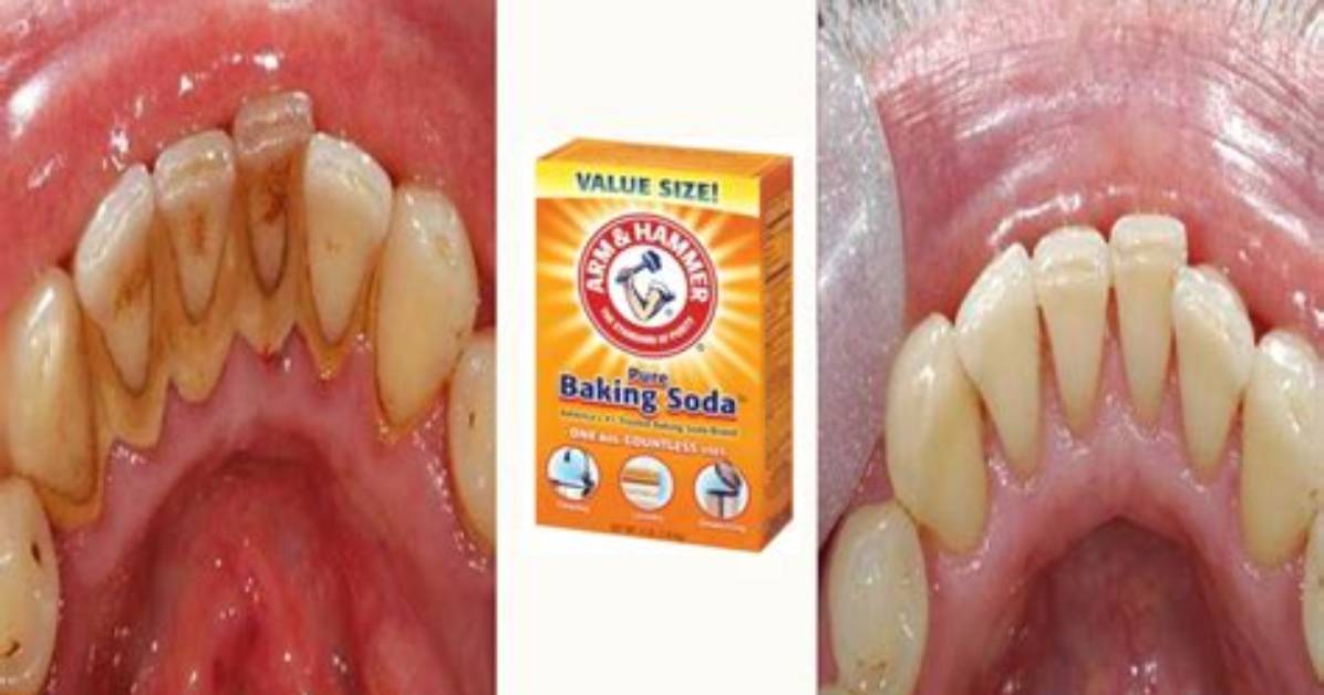 Does Baking Soda Remove Plaque?