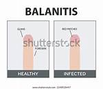 Does Balanitis Go Away?