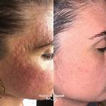 Does Beyaz Help with Acne