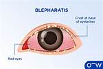 Does Blepharitis Make You Tired?