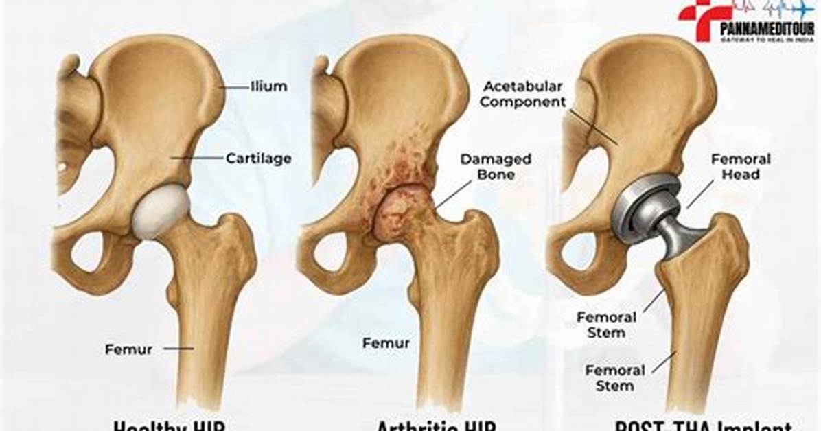 Does Bone on Bone Mean Hip Replacement?