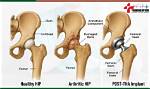 Does Bone on Bone Mean Hip Replacement?