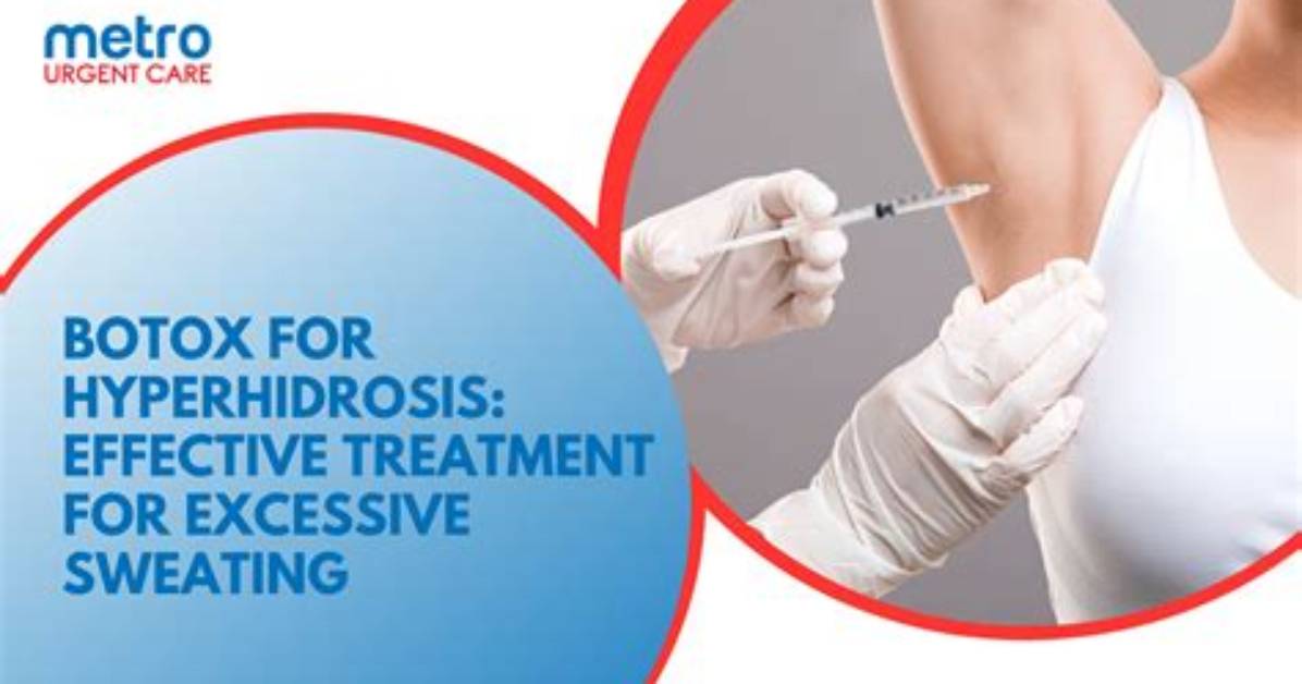 Does Botox Cause Compensatory Sweating?