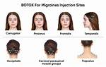 Does Botox Help Ocular Migraines?
