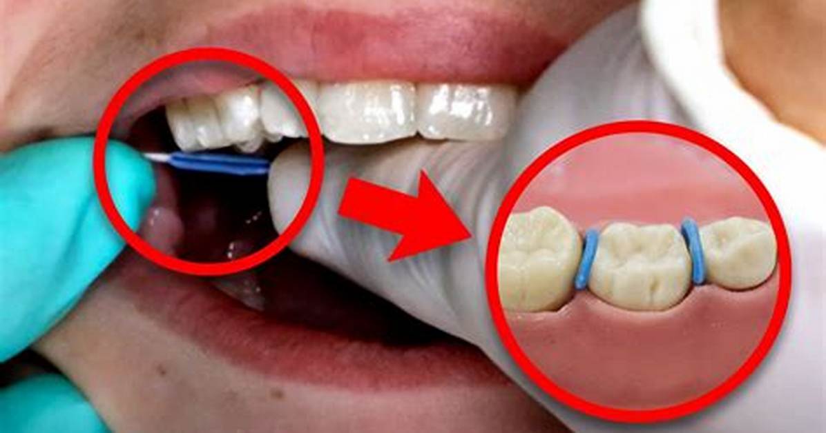 Does Braces Separators Hurt?