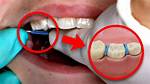 Does Braces Separators Hurt?