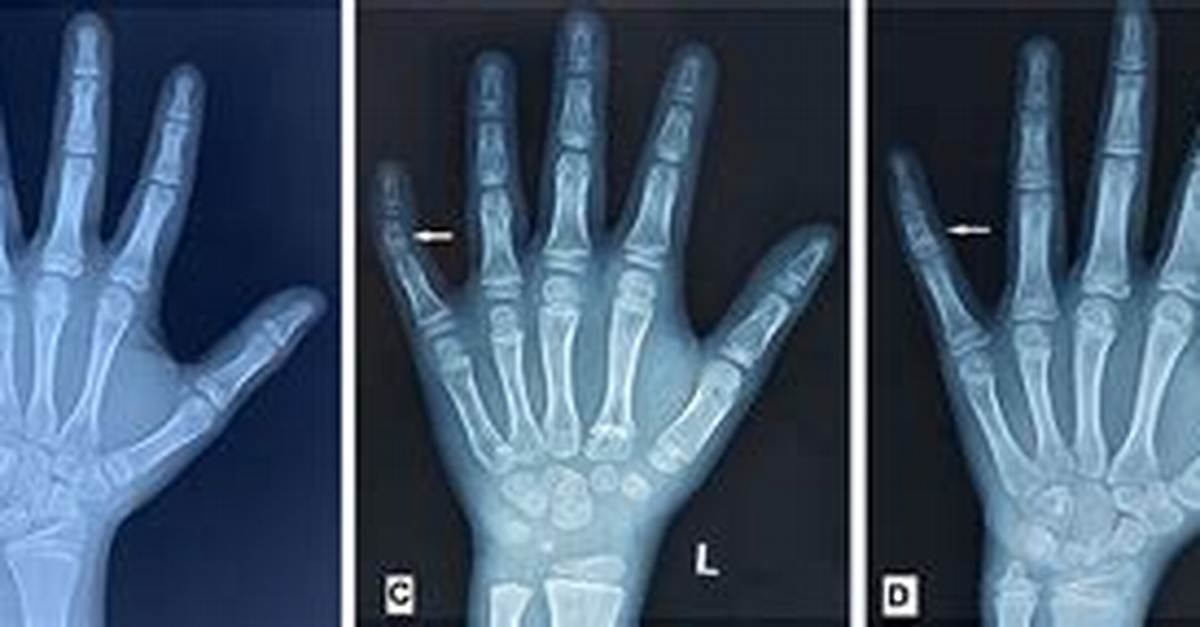 Does Brachydactyly Affect Height?