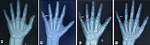 Does Brachydactyly Affect Height?